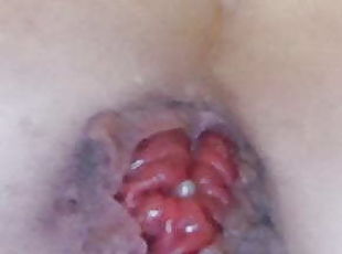 Anal push outs prolapse 